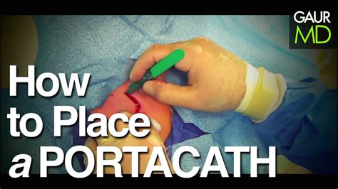 How to place a Portacath (Mediport Insertion) - YouTube