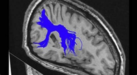 Neuroimaging research - Douglas Mental Health University Institute