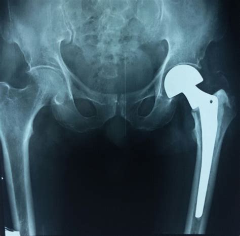 Case Study, Hip fracture, #AAOS Evidence Based Practice Guidelines — OrthopaedicPrinciples.com