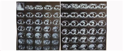 2 (A): CT Chest plain with contrast. | Download Scientific Diagram