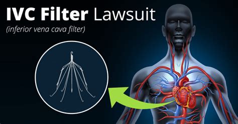 IVC Filter Complication Lawsuit | Attorney Jonathan Kline P.A.