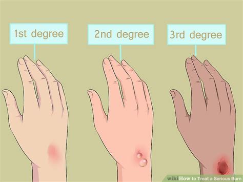 3 Ways to Treat a Serious Burn - wikiHow