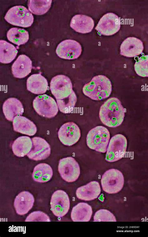 Plasmodium falciparum microscope hi-res stock photography and images ...