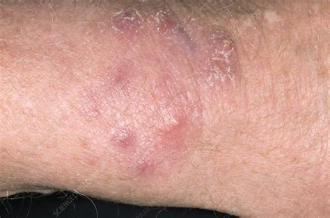 Ringworm skin infection - Stock Image - M270/0365 - Science Photo Library