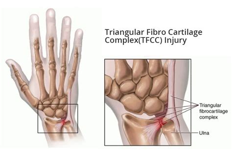 Triangular Fibrocartilage Complex (TFCC) Tear