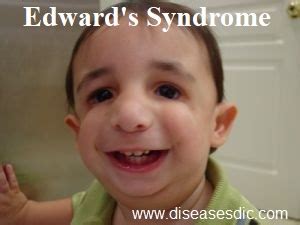 Edward’s Syndrome - Definition, Manifestations, and Treatment.