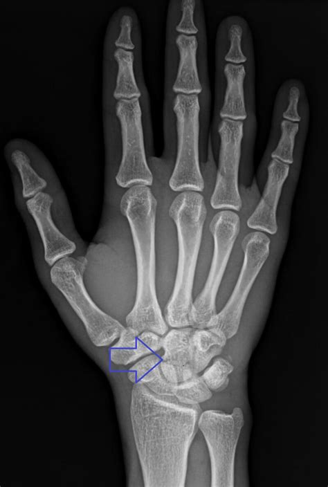 Capitate fracture - WikiProjectMed