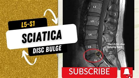 L5-S1 Disc bulge(Sciatica pain) Treatment - YouTube