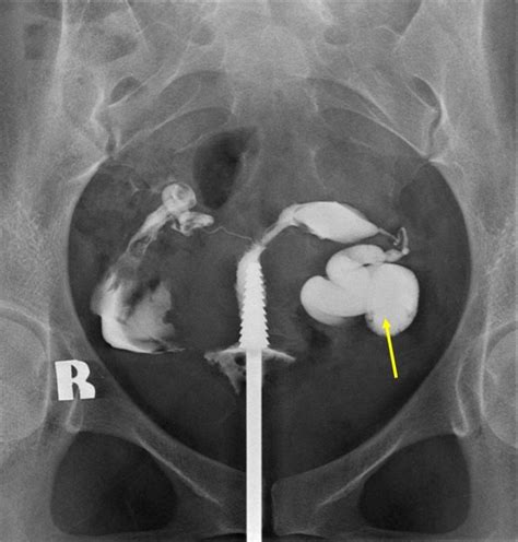 Hydrosalpinx – Radiology Cases