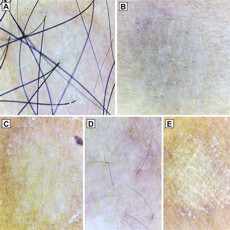 Dermoscopy (original magnification 10×) showing different patterns of... | Download Scientific ...