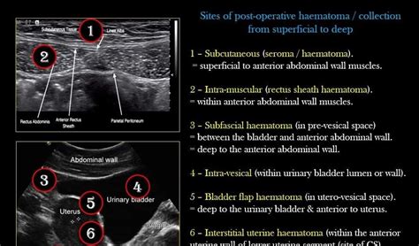 80 Best of Pouch Of Douglas Cyst Ultrasound - insectza