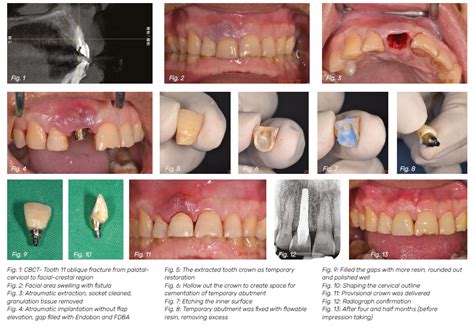 Anterior implant aesthetics - Dental Asia