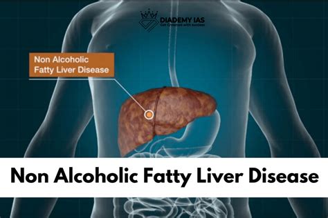 What is Non Alcoholic Fatty Liver Disease? - DIADEMY IAS