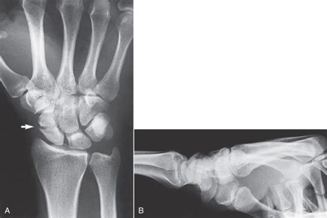 Carpal Fractures | Anesthesia Key