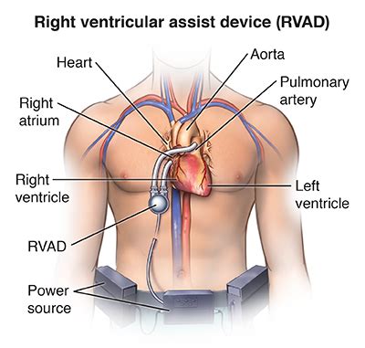 Right Ventricular Assist Device Implantation | Saint Luke's Health System