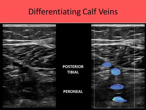 Gastrocnemius Vein Ultrasound