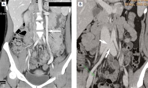 Computed venography. (A) Arrow indicates a dilated left gonadal vein ...