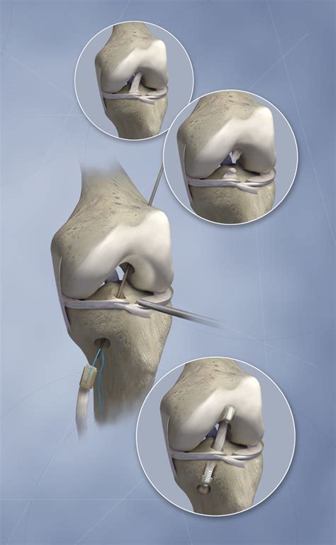 Knee Surgery - A KYU Design