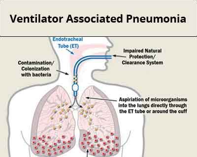 Ventilator Associated Pneumonia Protocol