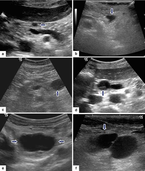 Intraductal Papillary Mucinous Neoplasm (IPMN) | Radiology Key