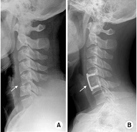 Cureus | Sub-Axial Cervical Facet Dislocation: A Review of Current Concepts