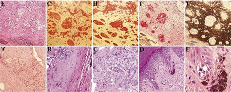 Histopathology of acral lentiginous melanoma. A. Multiple dysplastic... | Download Scientific ...