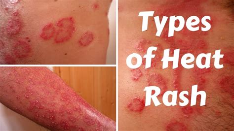 Types of Heat Rash - YouTube