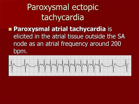 What Is Ectopic Atrial Tachycardia And How Is It Treated | Images and Photos finder