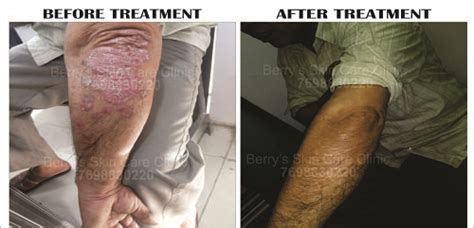 Plaque Psoriasis Treatment, Treatment for Plaque psoriasis - Berry Skin ...