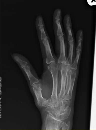 Rheumatoid arthritis x ray - wikidoc