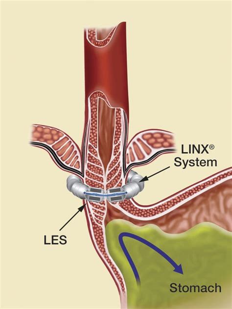 Acid reflux: LINX procedure offers alternative to lifelong medication