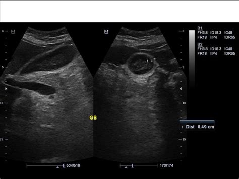 Systemic lupus erythematosus ultrasound or echocardiography - wikidoc