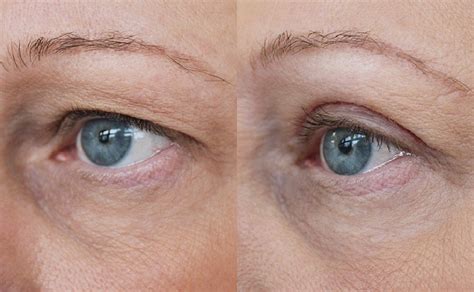 Upper Blepharoplasty - Eyelid Surgery Leeds - Skin Surgery Clinic