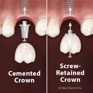 Choosing a Screw or Cement to Attach an Implant Crown - Three Fountains Family Dental Inc