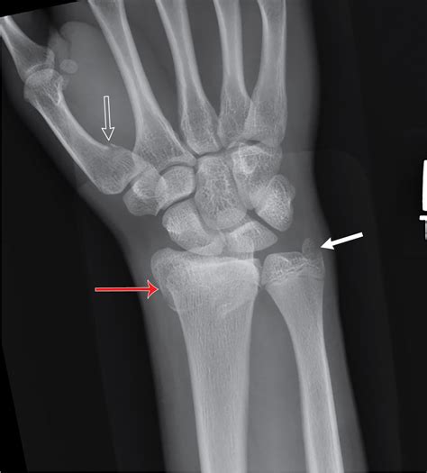 Growing pains: Salter-Harris classification of physeal injuries ...