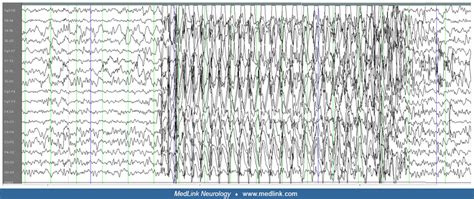 Typical absences | MedLink Neurology