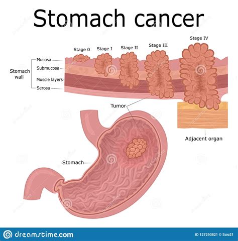 Illustration of Stomach Cancer Stock Vector - Illustration of anatomy ...