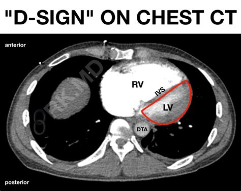 D-Sign: Right Ventricular Strain On Chest CT And Echocardiography | RK.MD