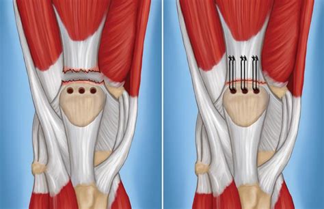 Quadriceps Tendon Anatomy