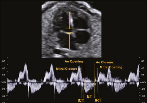 SciELO - Brasil - Spectral Doppler, tissue Doppler, and speckle-tracking echocardiography for ...