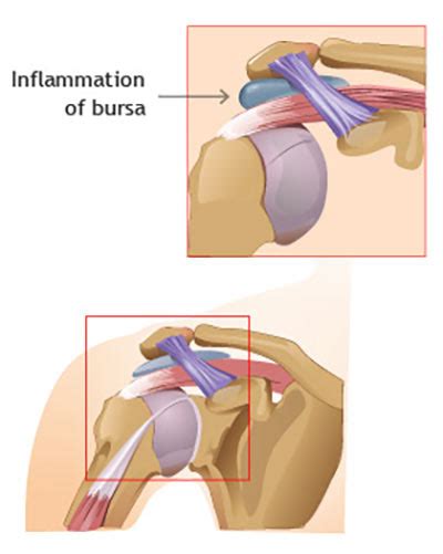 Shoulder Bursitis Treatment in New York City