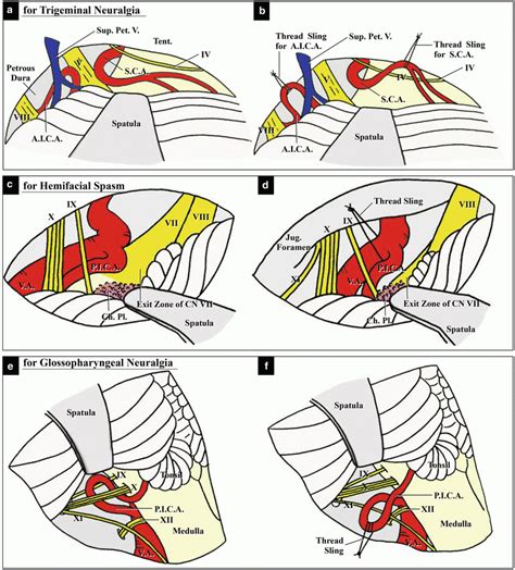 Anatomy for Microvascular Decompression Procedures: Relationships Between Cranial Nerves and ...