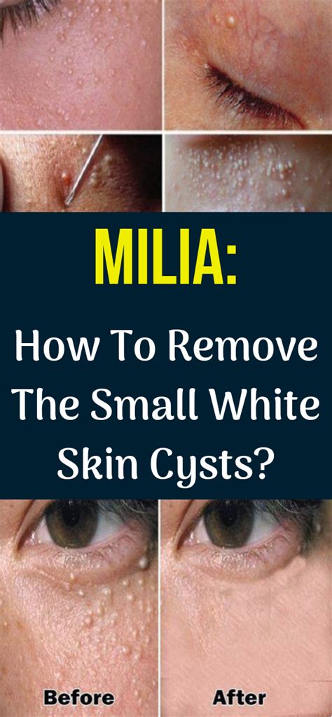 How to eliminate milia naturally | Wellness Today