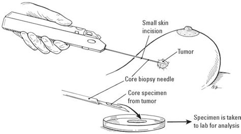 Diagnosing and treating breast cancer in Uganda - a Charities ...