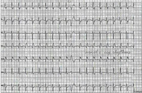 ECG Rhythms: Utility of a PVC in Arrhythmia Diagnosis