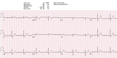 Lateral STEMI or Occlusion MI? | ECG cases | Emergency Medicine Cases