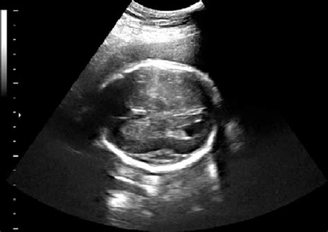 Prenatal ultrasound at 31 weeks' gestation showing ventriculomegaly and... | Download Scientific ...