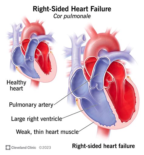 Cor Pulmonale: Symptoms and Causes