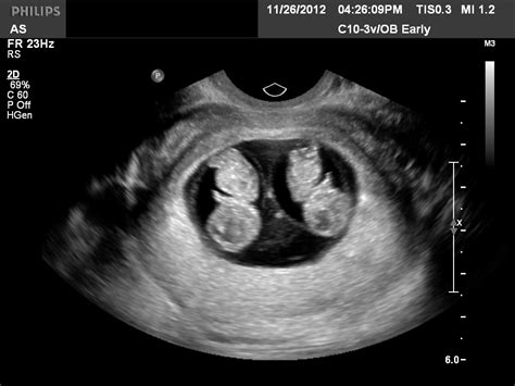 Diagnostic Ultrasound in the First Trimester of Pregnancy | GLOWM