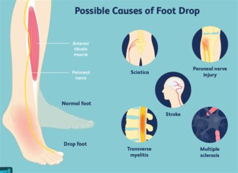 What's Causing Your High Steppage Gait? Symptom, Not Problem